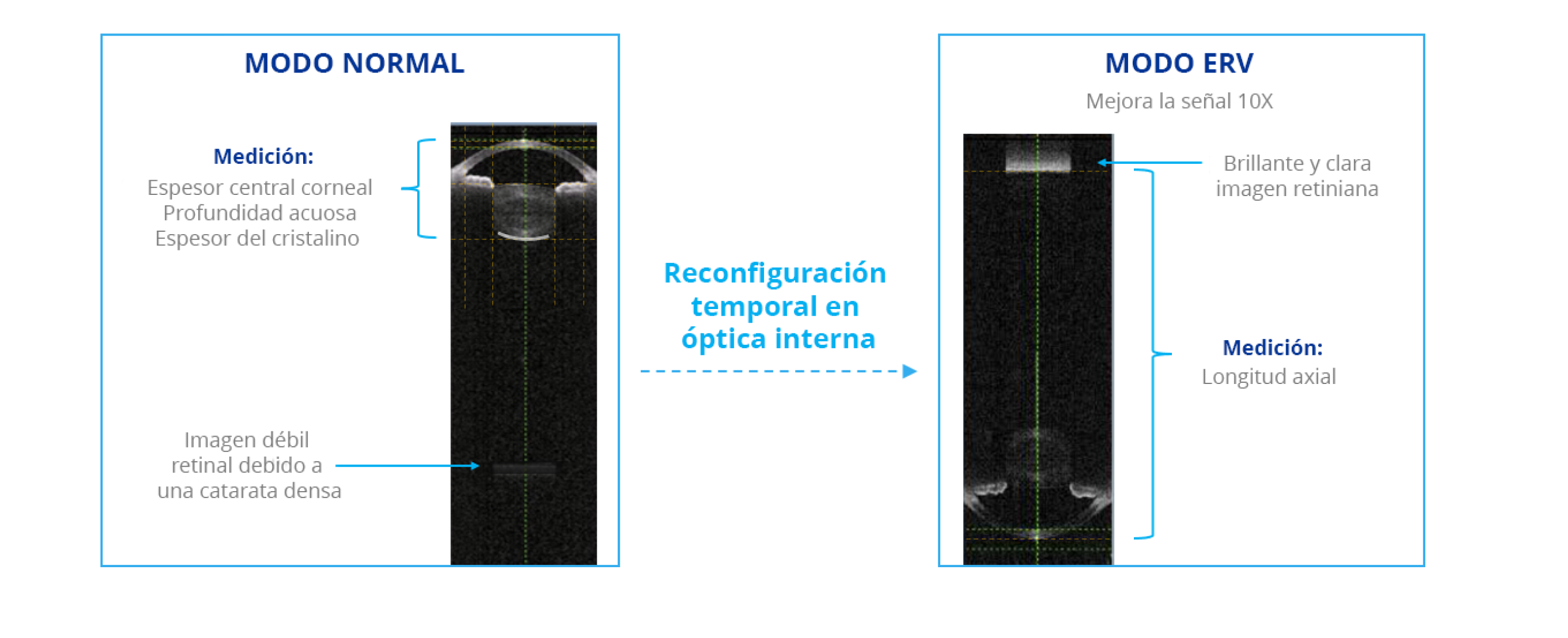 Comparación de imágenes de biometría capturadas por el biómetro de ARGOS en modo normal y en modo de visualización de retina mejorada (ERV). El modo ERV reconfigura la óptica interna para mejorar la señal en la retina 10 veces comparado con el modo normal.