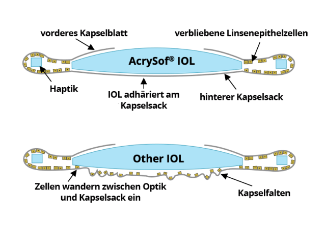 2 Abbildungen. Die erste zeigt die AcrySof IOL, die mit der hinteren Kapsel verklebt ist, ohne dass Zellen migrieren. Die zweite Abbildung zeigt andere IOL, bei denen die Zellen zwischen Optik und hinterer Kapsel wandern.