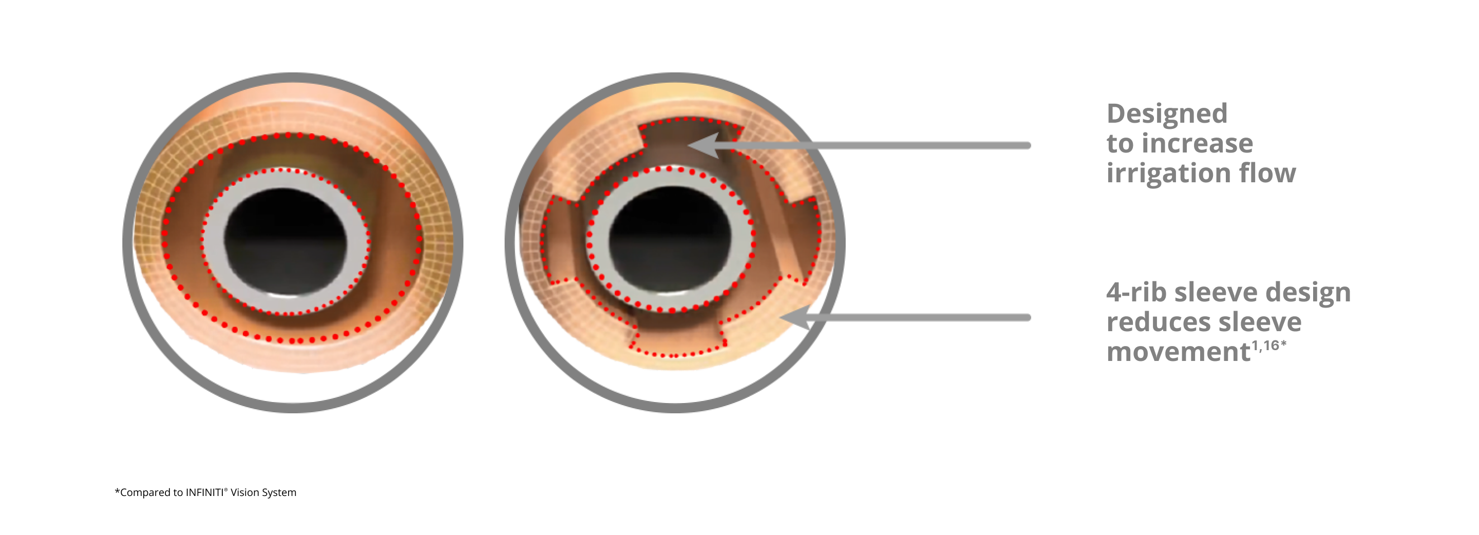 An image of that showcases the INTREPID irrigation sleeve with a 4-rib sleeve design which reduces sleeve movement and increases irrigation flow compared to the INFINITI Vision System