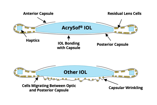 2 illustrations. The first one shows the AcrySof IOL bonded with the posterior capsul with not cell migration. The second illustration shows other IOLs with cells migrating between the optic and posterior capsule.