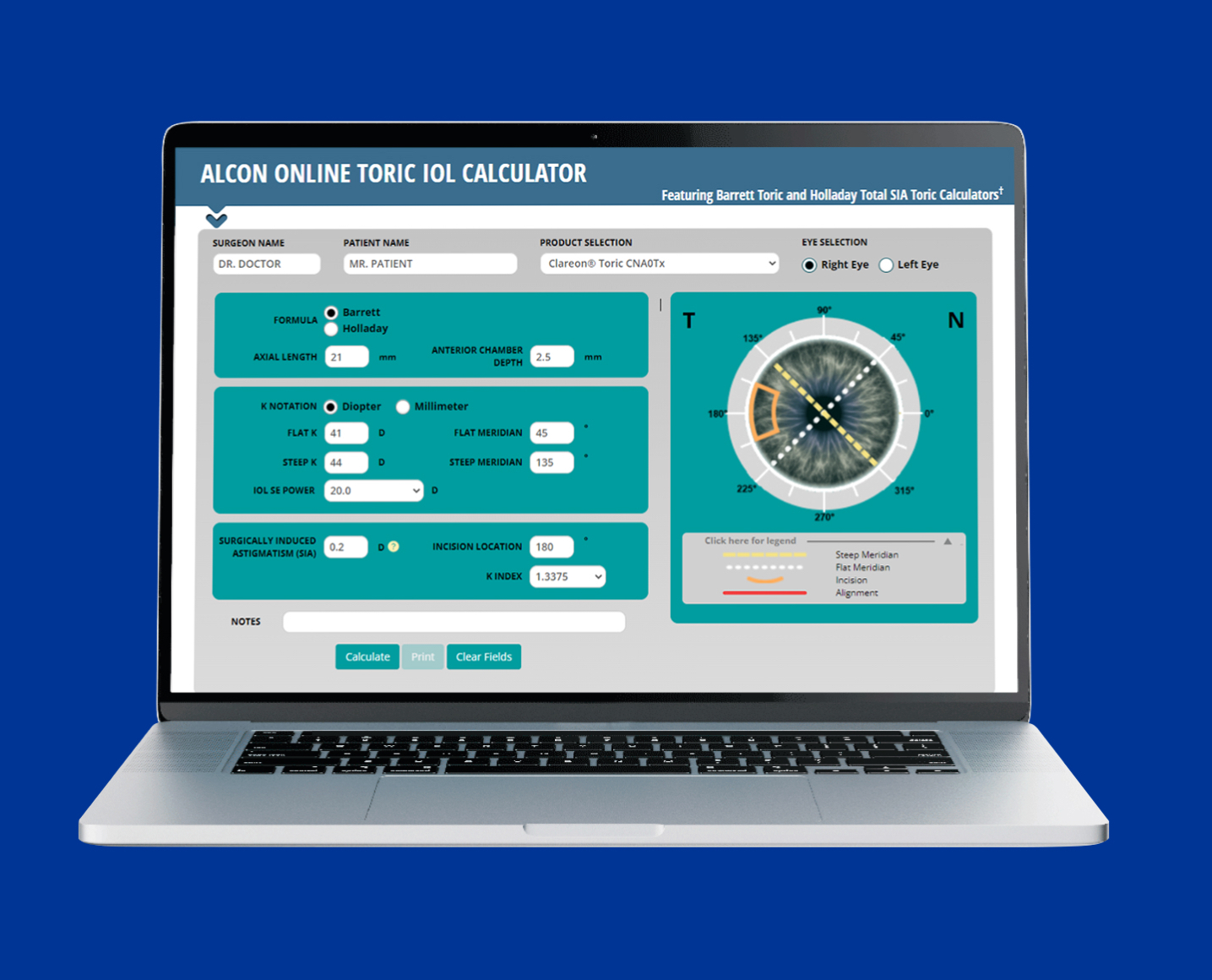 An image of an open laptop with the Alcon Online Toric IOL Calculator featured on the screen.