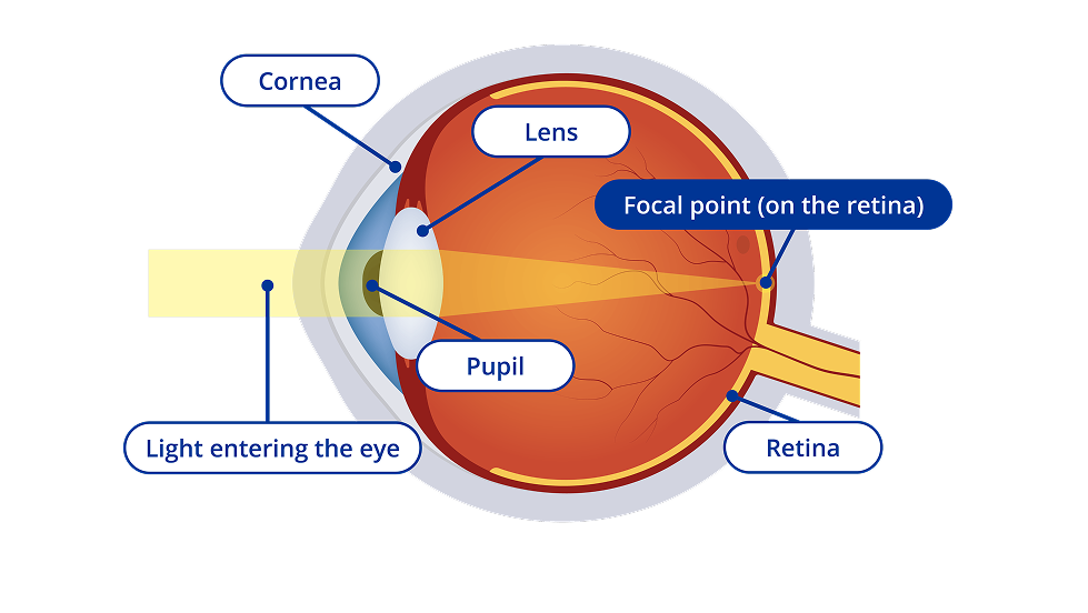 A diagram of the interior of an eye with clear vision. The diagram has yellow light entering the eye and the focal point of the light hits the retina. Certain areas of the eye are highlighted. These areas are the cornea, the lens, the pupil and the retina.