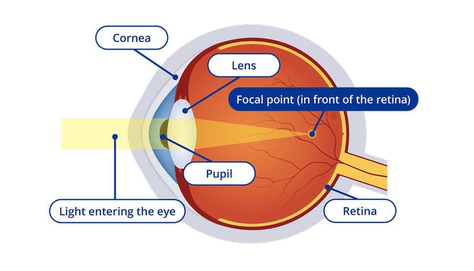 A diagram of the interior of an eye with nearsightedness or myopia. The diagram has yellow light entering the eye and the focal point of the light appears in front of the retina. Certain areas of the eye are highlighted. These areas are the cornea, the lens, the pupil and the retina.