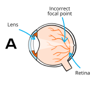 Infographic of eye