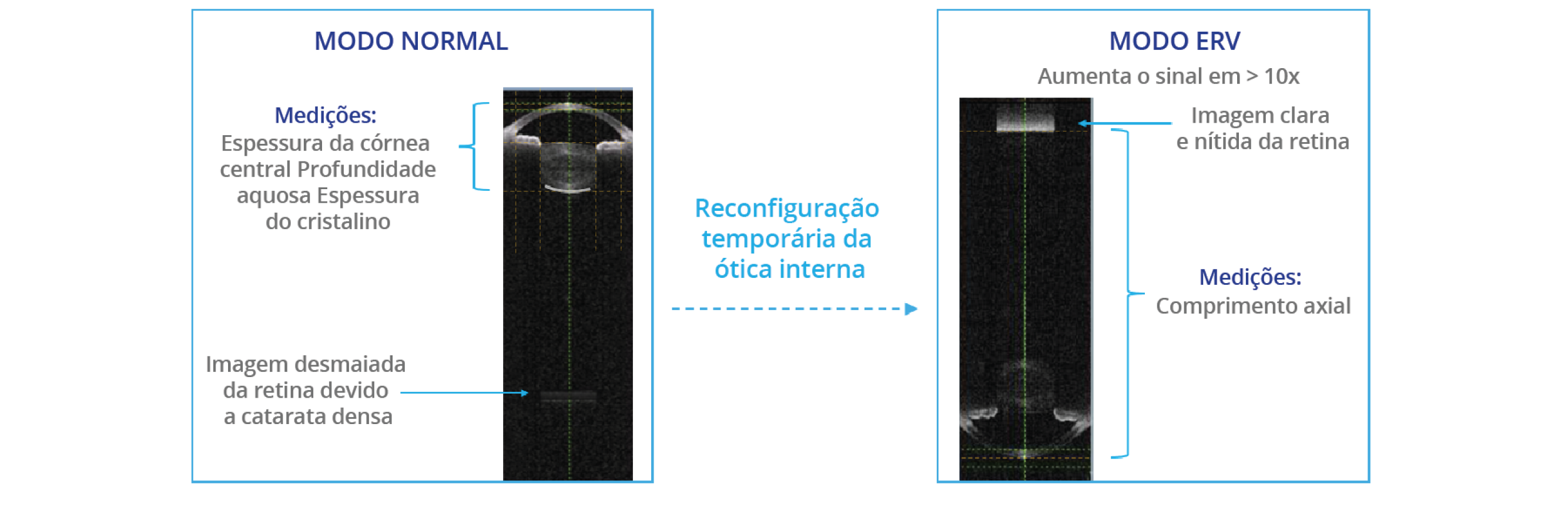 Comparação de imagens biométricas capturadas pelo Biómetro ARGOS em modo normal e em modo de visualização aprimorada da retina (ERV). O modo ERV reconfigura a óptica interna para melhorar o sinal na retina em 10 vezes em comparação com o modo normal.