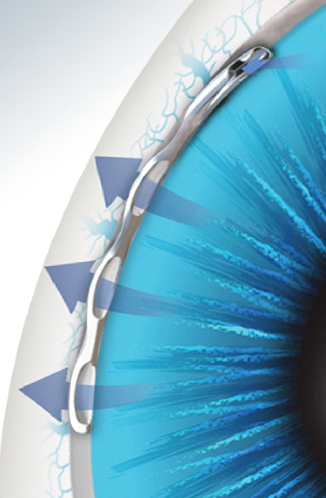 Glaucoma Surgery See More Product Page Button
