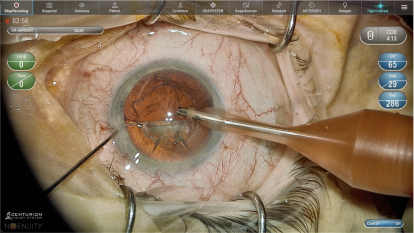 Close-up of the eye surgery