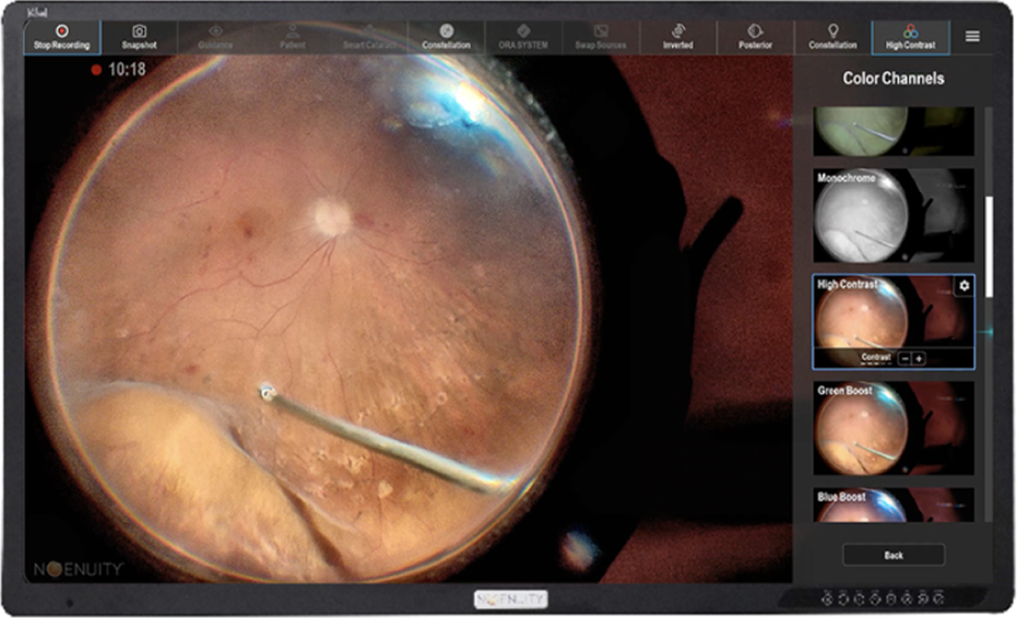 Close-up of the eye surgery
