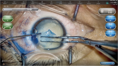 Close-up of the eye surgery