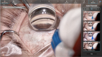 Close-up of the eye surgery