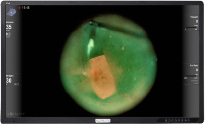 Close-up of the eye surgery