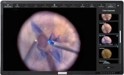 Close-up of the eye surgery