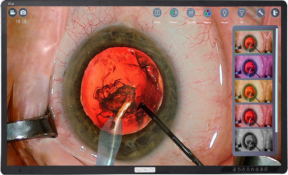 Close-up of the eye surgery
