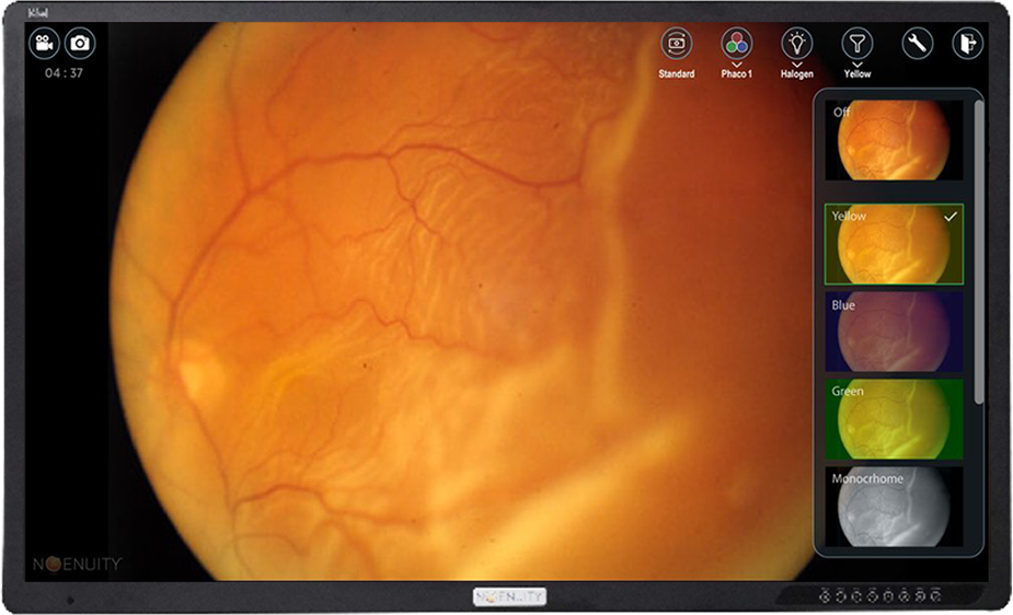 Close-up of the eye surgery