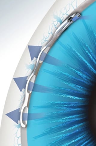 Glaucoma Surgery See More Product Page Button