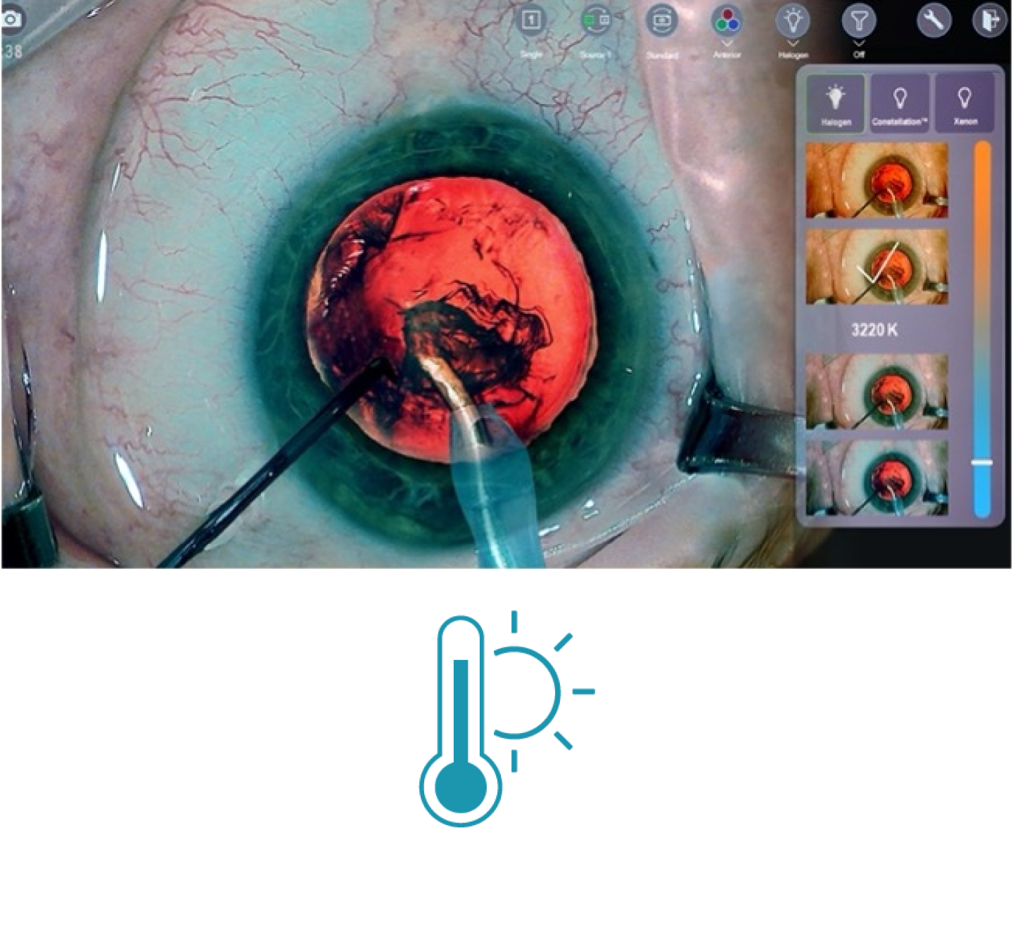 A closeup image of an eye during surgery with surgical tools on screen Thumbnails on the right side of the screen show the different light temperature filters available with NGENUITY 3D Visualization System.  A blue icon showing a thermometer with the sun behind it 