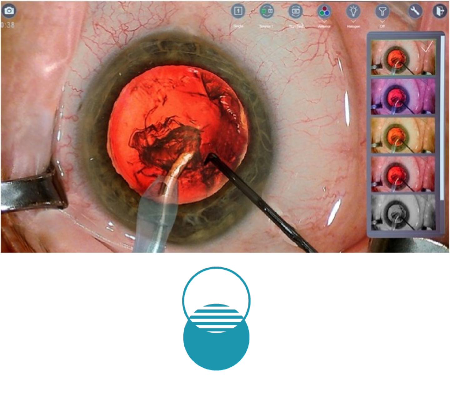 A closeup image of an eye during surgery, with surgical tools on screen. Thumbnails on the right side of the screen show the different colour filters available with NGENUITY 3D Visualization System. A blue icon showing two circles overlapping each other 