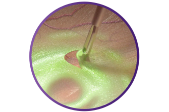 Vergrößerung der SHARKSKIN ILM Pinzette, die Gewebe greift, um die Peelingfunktion zu zeigen.