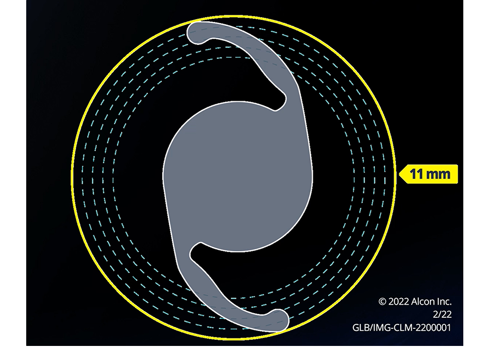 An image of an IOL in a yellow circle over a black background. An arrow pointing to the yellow circles says “11 mm”. A play button appears over the image indicating that this is a video. 