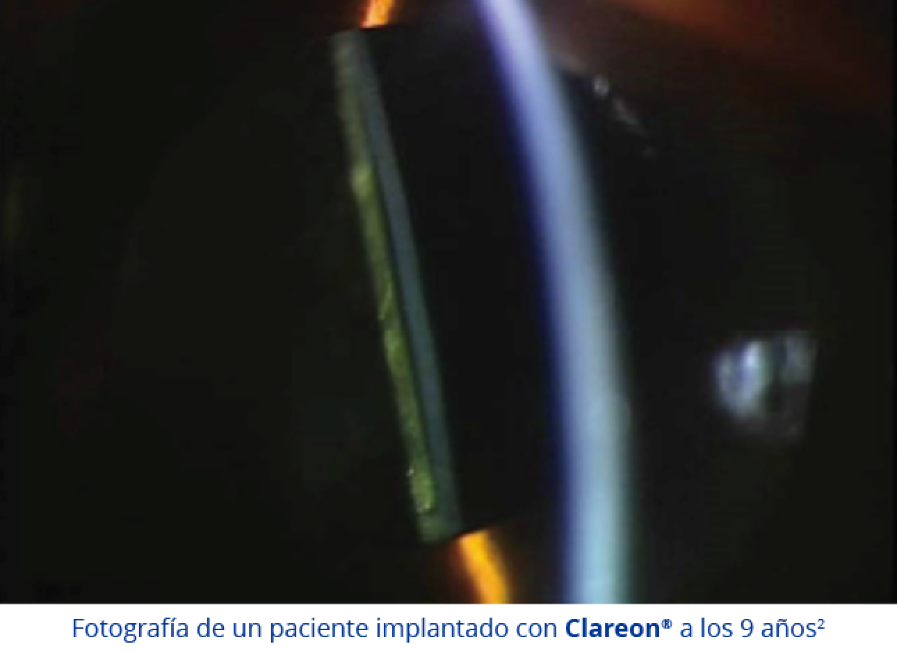 Esta imagen es una fotografía de un ojo de un paciente a los 9 años de la implantación de una LIO Clareon.