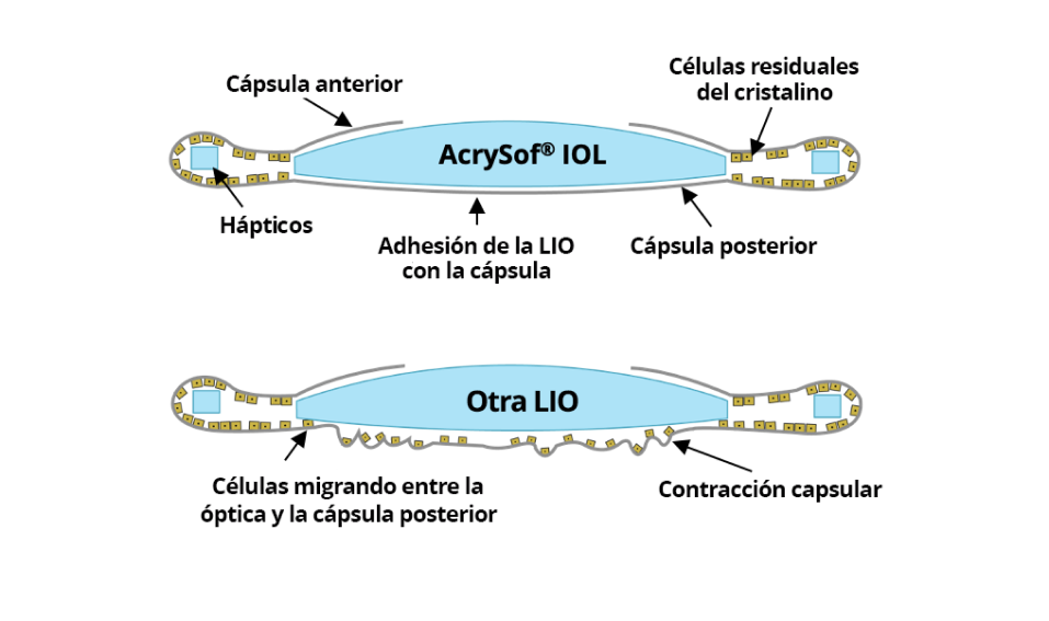 2 ilustraciones. La primera muestra la LIO AcrySof unida con la cápsula posterior sin migración de células. La segunda ilustración muestra otras LIOs con células migrando entre la óptica y la cápsula posterior.
