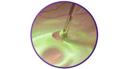 Vergrößerung der SHARKSKIN ILM Pinzette, die Gewebe greift, um die Peelingfunktion zu zeigen.