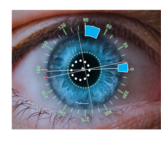 Die Vergrößerung eines Auges, auf das ein digitales Overlay gelegt ist, das Winkel und Inzisionspositionierungen anzeigt.