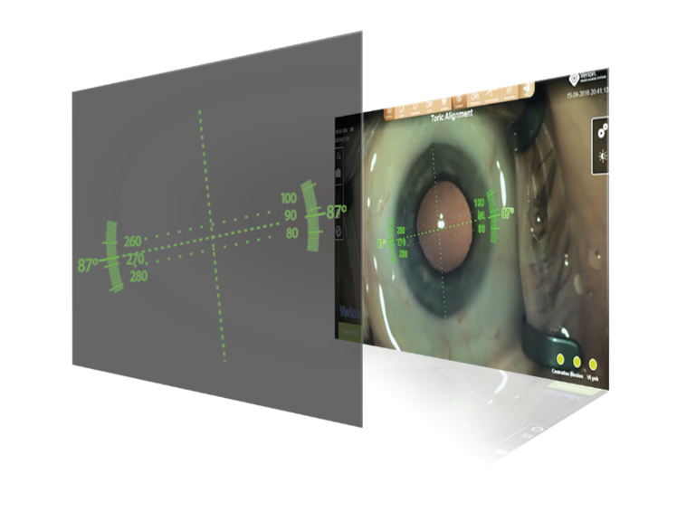Ein Bild aus zwei Ebenen, das ein Auge zeigt und die Benutzeroberfläche, über die das Auge mit dem ARGOS Biometer vermessen wird.