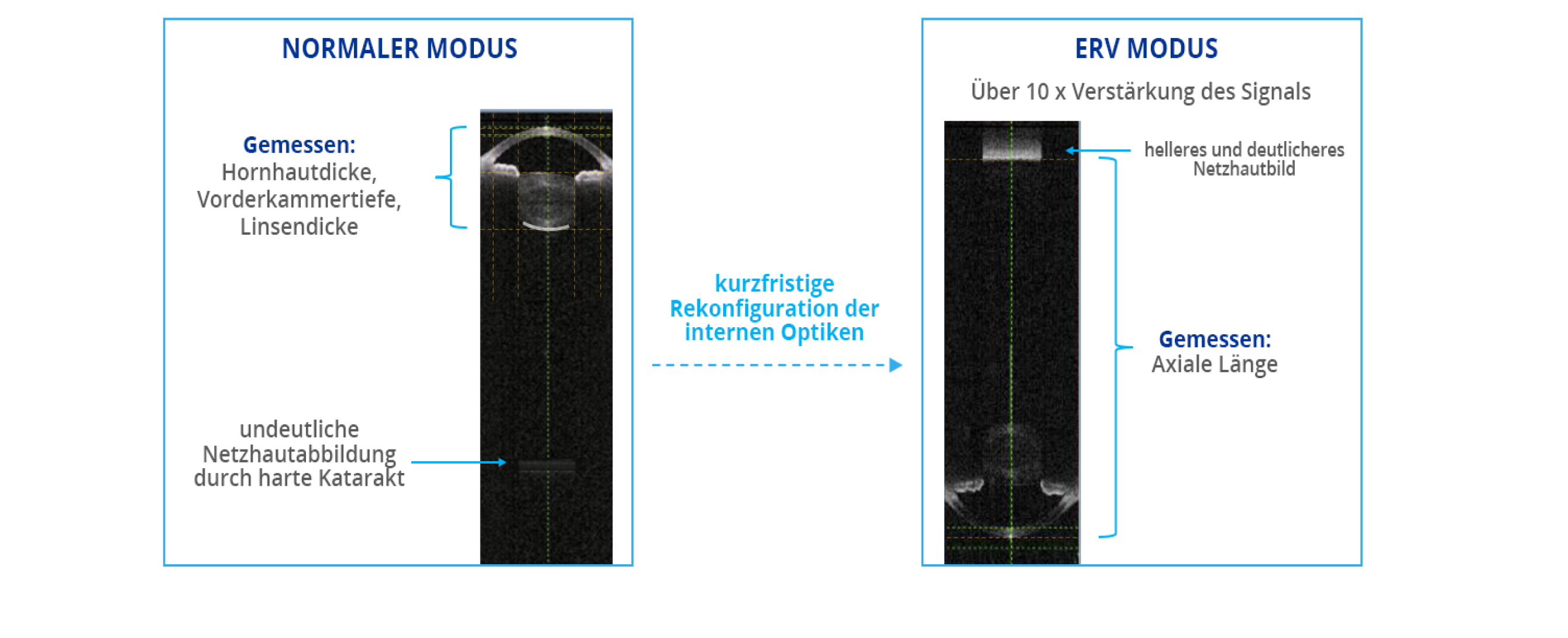 Ein Vergleich von Biometrieaufnahmen, die mit dem ARGOS Biometer in normalem Modus und im erweiterten Netzhautvisualisierungsmodus (ERV) aufgenommen wurden. Der ERV-Modus rekonfiguriert die internen Optiken, um das Signal um das 10-Fche im Vergleich zum normalen Modus zu verstärken.