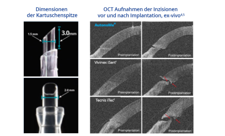 Zwei zusammengehörende Bilderblöcke nebeneinander. Die linken Aufnahmen zeigen eine Nahaufnahme der Kartuschenspitze des AutonoMe® mit einem Text, der besagt, dass die Länge der Kartuschenspitze 3,0 mm und der Durchmesser 2,0 mm beträgt.    Die rechten Aufnahmen zeigen die Inzisionen vor und nach der Implantation mit AutonoMe®, Vivinex und Tecnis. Der blaue Text am oberen Bildrand besagt: “OCT-Aufnahmen vor und nach Implantation, ex vivo.” Rote Pfeile auf den Bildern zu Tecnis und Vivinex zeigen eine Beschädigung der Descemet Membran nach Implantation ex vivo an.