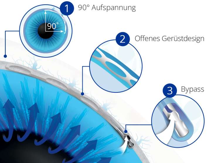 Eine Nahaufnahme des in einem Auge implantierten Hydrus Microstents. Dunkelblaue Pfeile zeigen den Fluss in Richtung des Implantats an. Drei runde, von eins bis drei nummerierte Bilder markieren die Stellen, an denen die verschiedenen Abschnitte des Implantats im Auge liegen. Das vergrößerte Bild Nummer eins zeigt einen Winkel von 90° an, Bild Nummer zwei zeigt das offene Gerüstdesign und Nummer drei zeigt den Bypass an.
