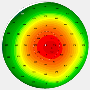 Farbcodierte Pachymetriekarte der Hornhautdicke mit Messwerten.
