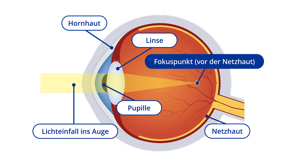 Ein Diagram vom Inneren eines kurzsichtigen Auges. Das Diagram zeigt einen gelben Lichtstrahl, der in das Auge eintritt und der Fokuspunkt liegt vor der Netzhaut. Bestimmte Bereiche des Auges sind hervorgehoben. Diese Bereiche sind die Hornhaut, die Linse, die Pupille und die Netzhaut.