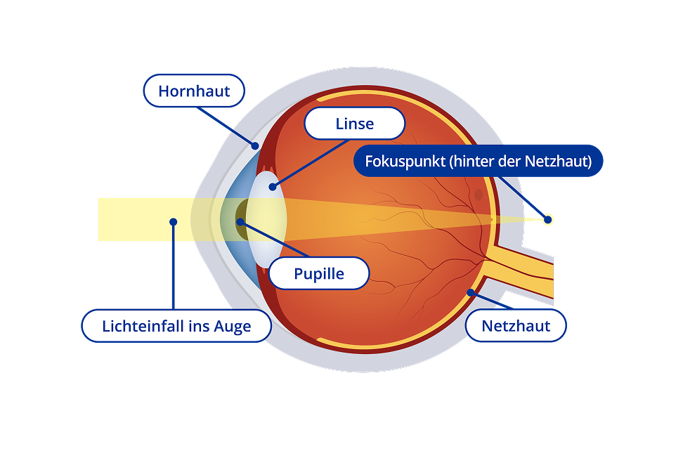 Ein Diagram vom Inneren eines weitsichtigen Auges. Das Diagram Fokuspunkt liegt hinter der Netzhaut. Bestimmte Bereiche des Auges sind hervorgehoben. Diese Bereiche sind die Hornhaut, die Linse, die Pupille und die Netzhaut.