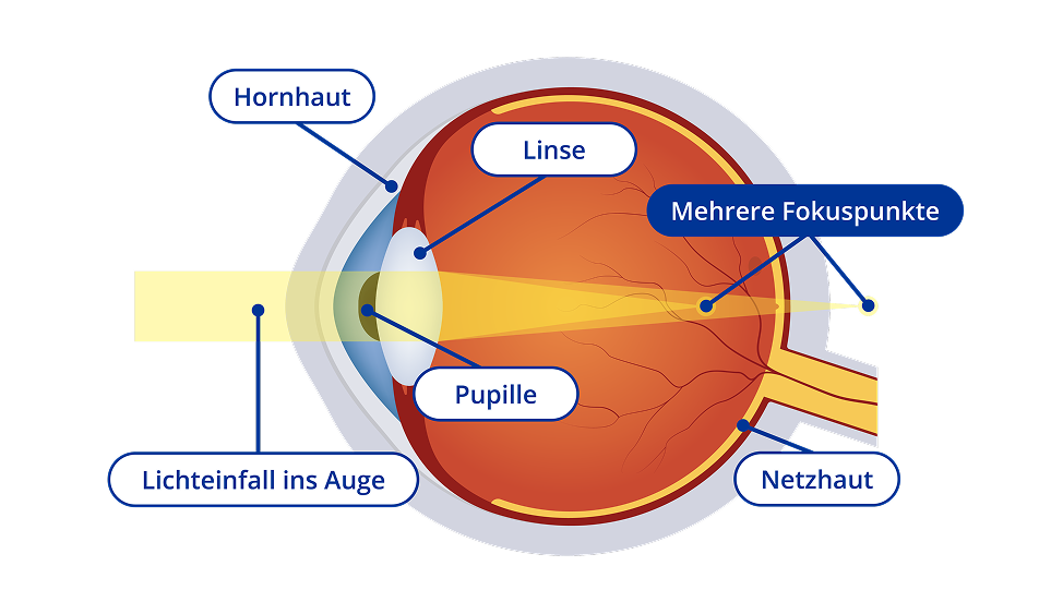 Ein Diagram vom Inneren eines Auges mit Astigmatismus. Das Diagram zeigt einen gelben Lichtstrahl, der in das Auge eintritt und der Fokuspunkt liegt sowohl vor, als auch hinter der Netzhaut. Bestimmte Bereiche des Auges sind hervorgehoben. Diese Bereiche sind die Hornhaut, die Linse, die Pupille und die Netzhaut.