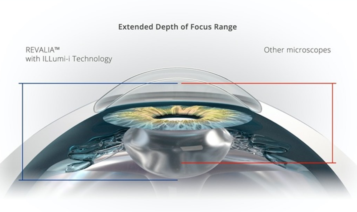 A cross-section of an eye showing the extended depth of focus with Revalia compared to other microscopes.
