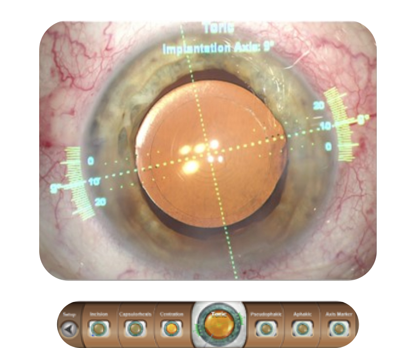 Primer plano de un ojo con superposición digital de VERION™ que muestra el eje tórico de implantación.