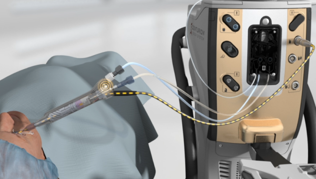 Imagen animada del CENTURION Vision System y pieza de mano ACTIVE SENTRY junto a un paciente siendo operado. Una línea amarilla punteada destaca el sensor de presión de irrigación situado en la pieza de mano ACTIVE SENTRY.
