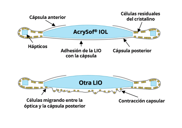 2 ilustraciones. La primera muestra la LIO AcrySof unida con la cápsula posterior sin migración de células. La segunda ilustración muestra otras LIOs con células migrando entre la óptica y la cápsula posterior.