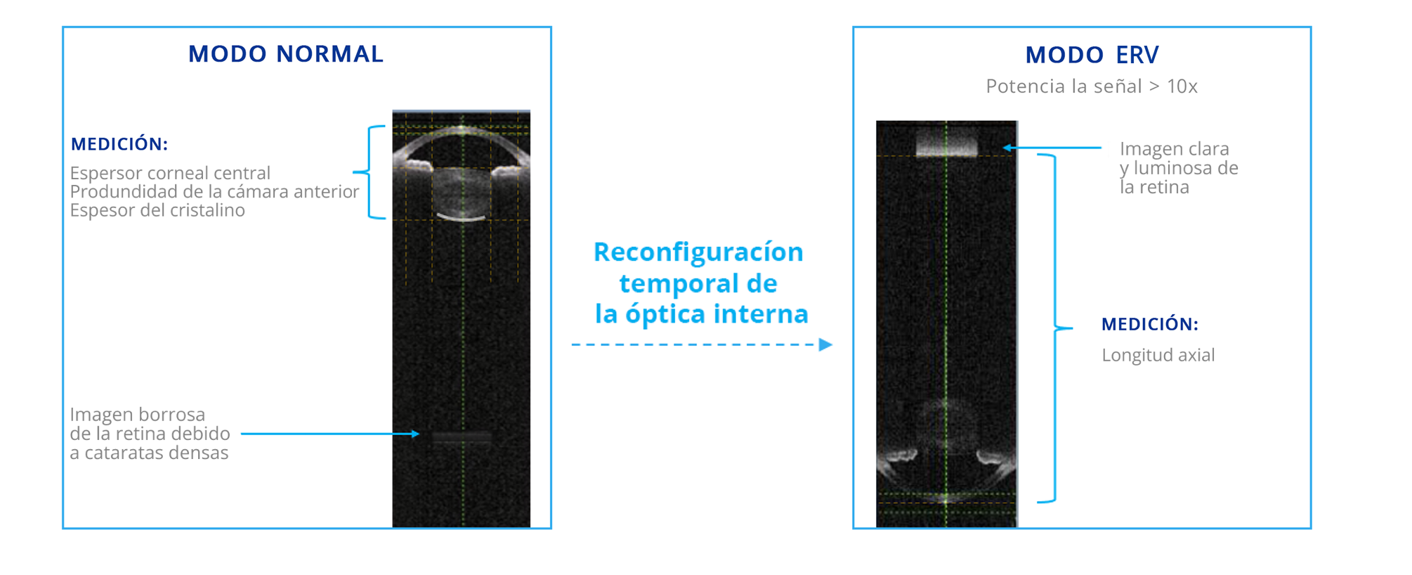 Comparación de imágenes de biometría capturadas por el biómetro de ARGOS en modo normal y en modo de visualización de retina mejorada (ERV). El modo ERV reconfigura la óptica interna para mejorar la señal en la retina 10 veces comparado con el modo normal.  