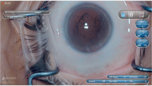 Image en gros plan d'un œil en cours d'opération, maintenu ouvert par des instruments chirurgicaux. Une incrustation numérique sur l'image montre les paramètres chirurgicaux et les réglages.