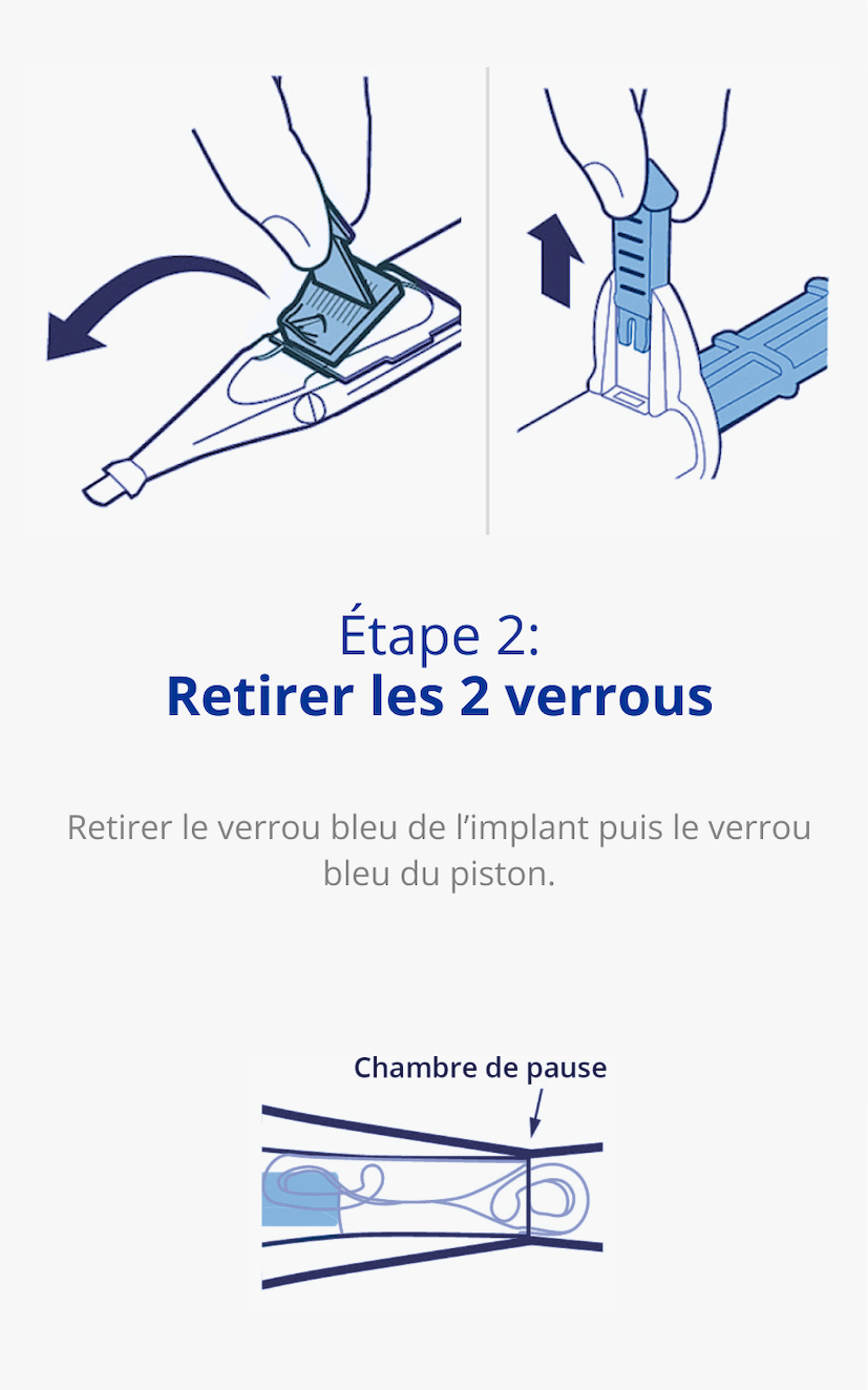 Deux illustrations de la deuxième étape de la préparation de l'implant UltraSert. Sur l'image de gauche, une main retire la butée de la lentille d'un dispositif UltraSert. Sur l'image de droite, une main retire le piston d'un dispositif UltraSert.