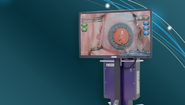 Image du système de visualisation 3D NGENUITY avec un écran affichant une vue rapprochée de la chirurgie oculaire. L'appareil apparaît sur un fond turquoise.