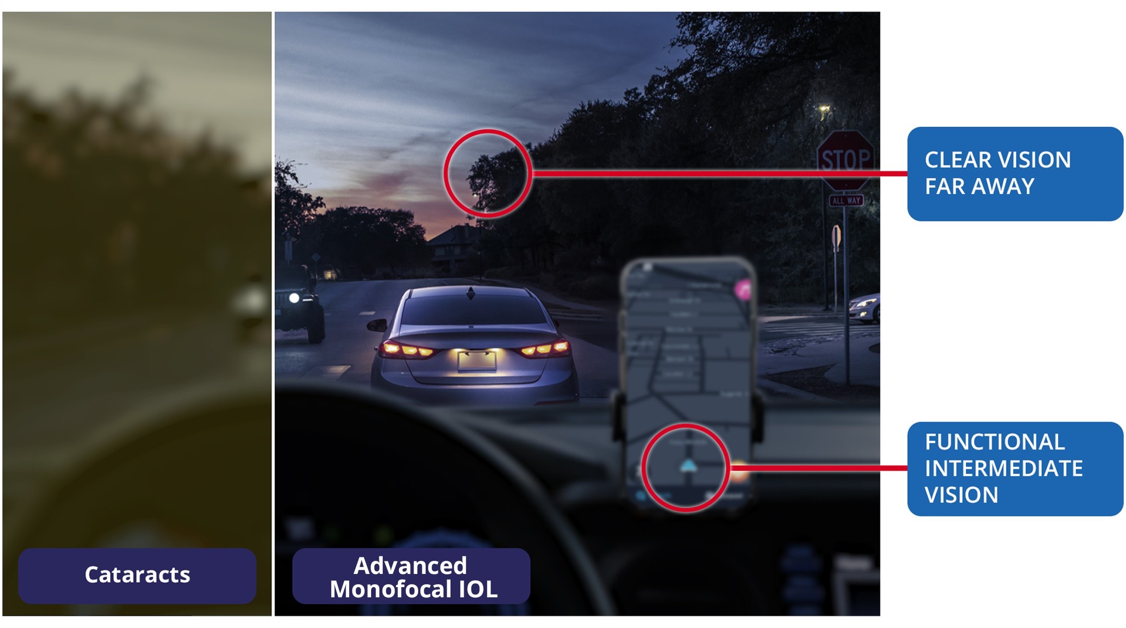 Side-by-side nighttime driving scene showing vision with cataracts compared to vision with an Advanced Monofocal IOL, highlighting clear distance vision and functional intermediate vision with the lens