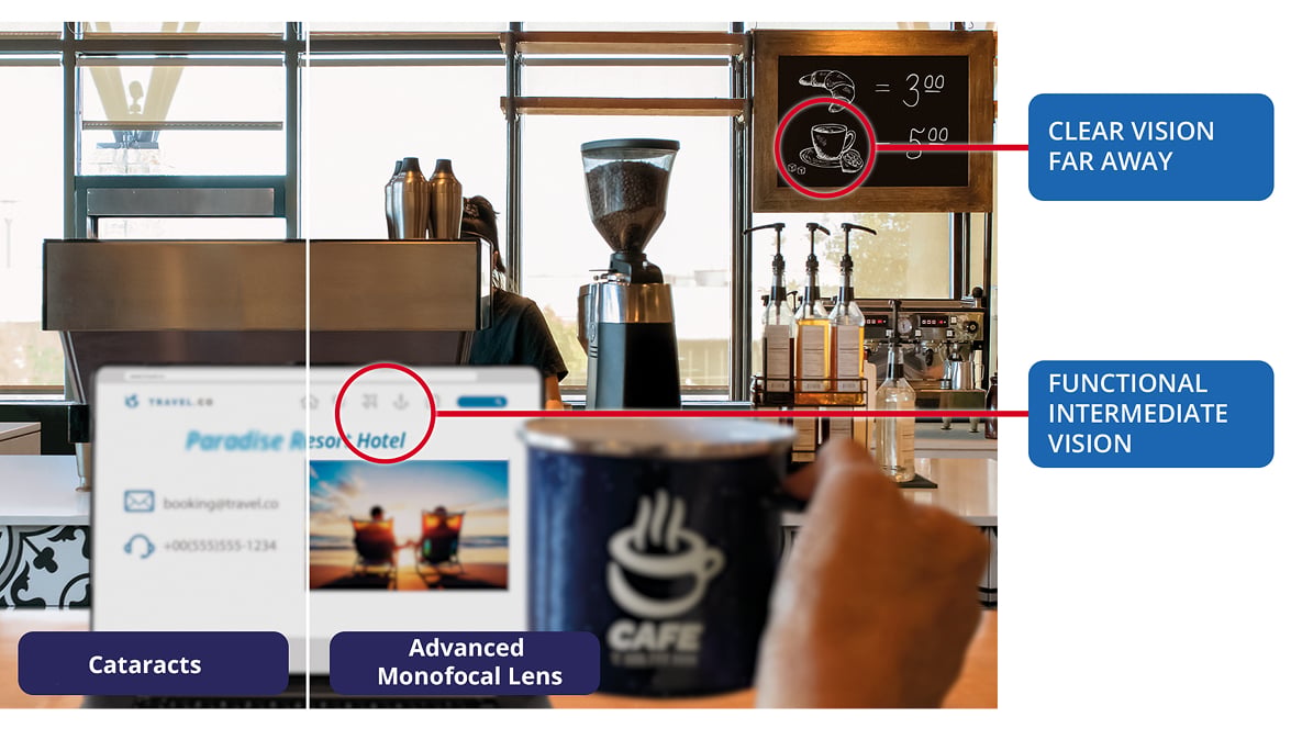 Side-by-side café scene showing vision with cataracts compared to vision with the Monofocal intraocular lens (IOL), highlighting clear distance vision and functional intermediate vision with the lens