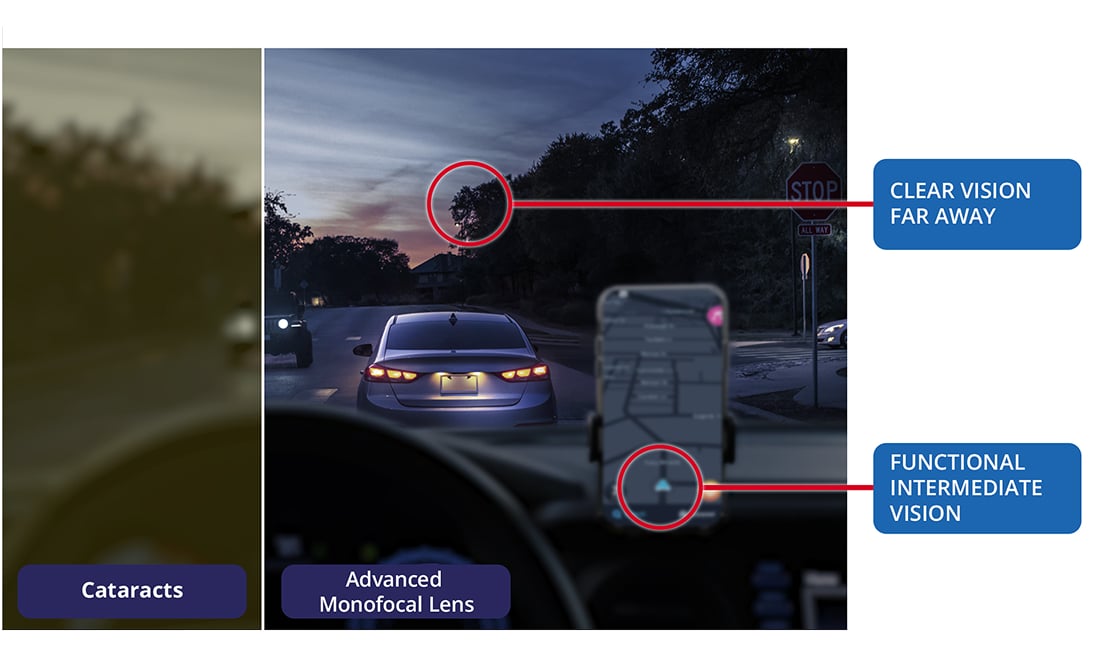Side-by-side nighttime driving scene showing vision with cataracts compared to vision with a Monofocal intraocular lens (IOL), highlighting clear distance vision and functional intermediate vision with the lens