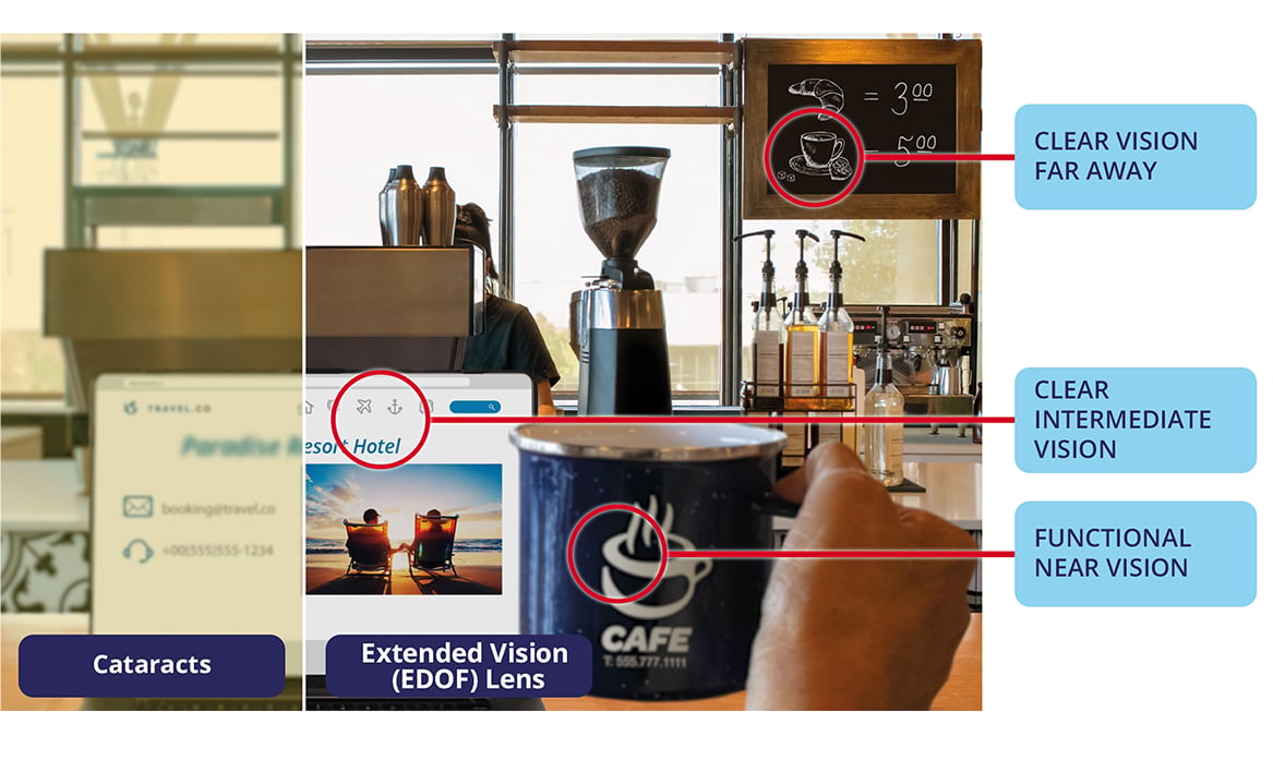Side-by-side café scene showing vision with cataracts compared to vision with an Extended Depth of Vision (EDOF) intraocular lens (IOL), highlighting clear distance vision, clear intermediate vision, and functional near vision with the lens