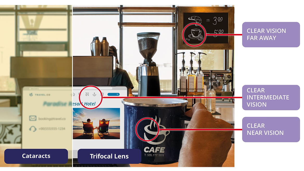 Side-by-side café scene showing vision with cataracts compared to vision with a trifocal intraocular lens (IOL), highlighting clear distance vision, clear intermediate vision, and clear near vision with the lens