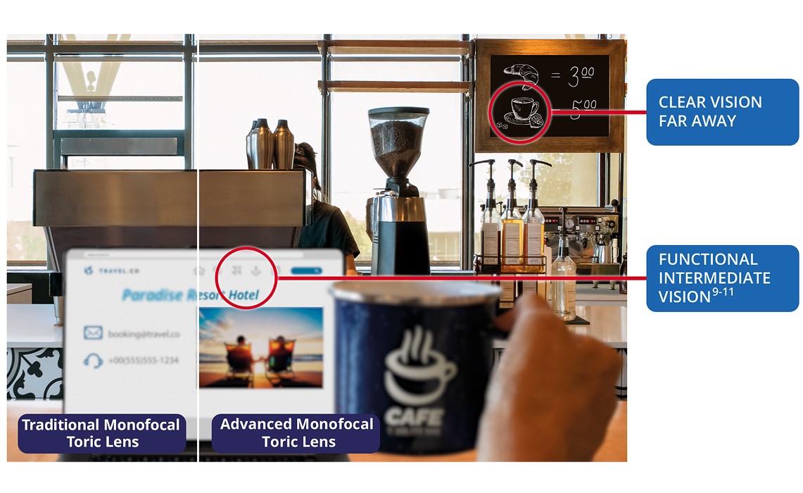 Side-by-side café scene comparing vision with a traditional monofocal intraocular toric lens and an advanced Monofocal Toric IOL, showing clear distance vision and functional intermediate vision with astigmatism correction