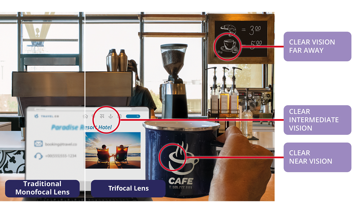 Side-by-side café scene illustrating vision with a traditional monofocal intraocular lens versus a trifocal IOL, showing clear distance, clear intermediate, and clear near vision with a trifocal cataract lens